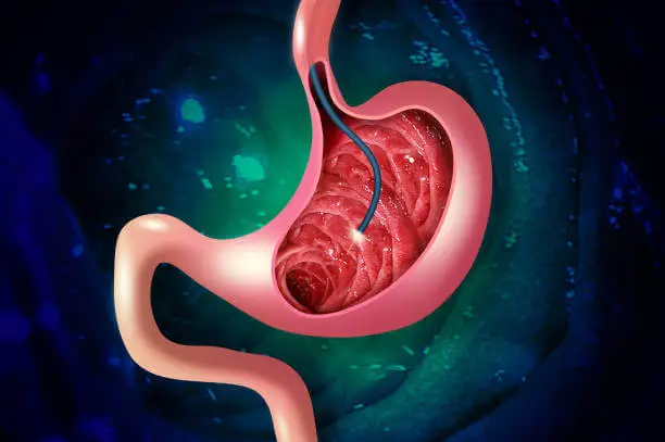 Izvedba postopka gastroskopije. Diagnostika želodčnih bolezni. Zdravje želodca.
